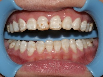 Traitement dyschromies dentaires à Bagnolet